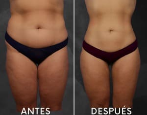 Antes y después cirugía plástica