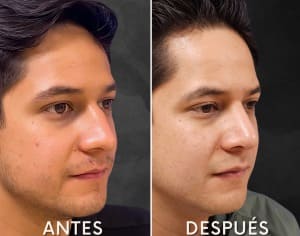 Antes y después cirugía estética