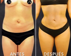 Antes y después cirugía reconstructiva