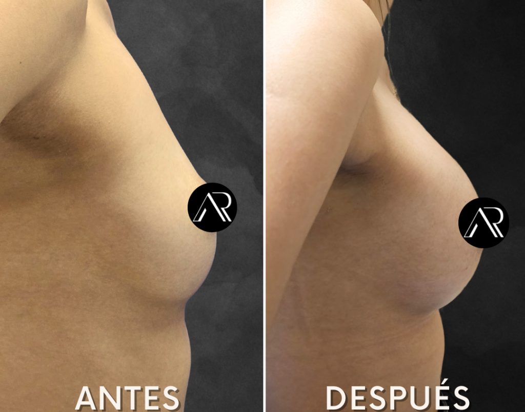 antes-despues-cirujano-plastico-02