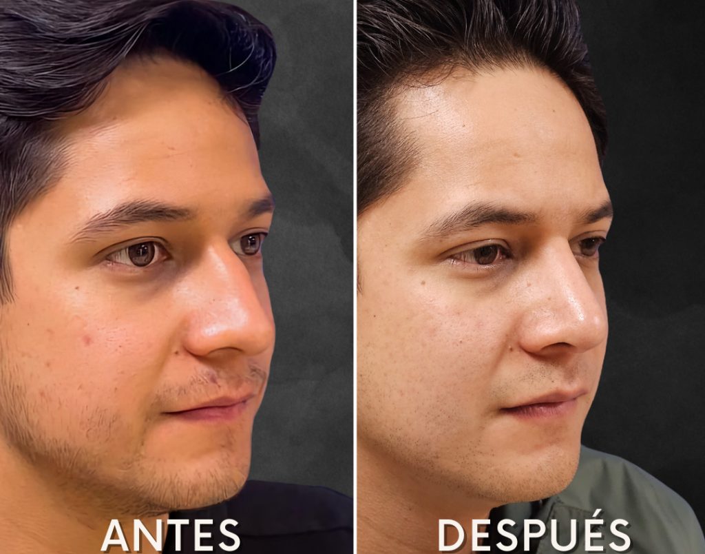 antes-despues-cirujano-plastico-03