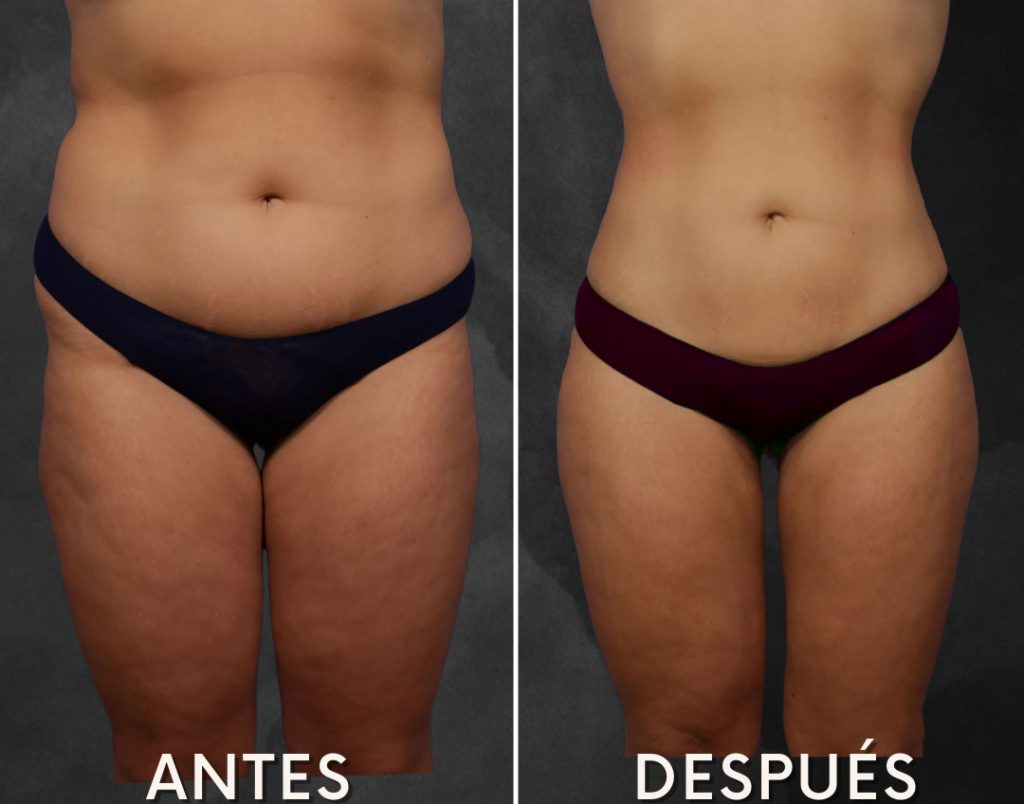 antes-despues-cirujano-plastico-04