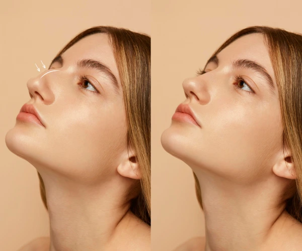 Costo de consulta con especialista en rinoplastia en Tijuana