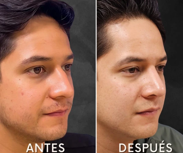 Precio de consulta con especialista en rinoplastia en Tijuana
