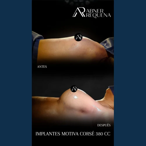 aumento-de-busto-en-tijuana-2