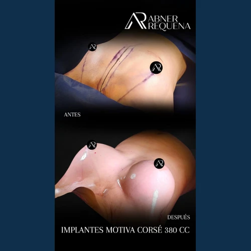 aumento-de-busto-en-tijuana-3