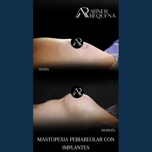 aumento-de-busto-en-tijuana-4