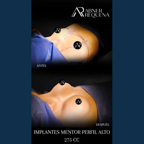 aumento-de-busto-en-tijuana-5